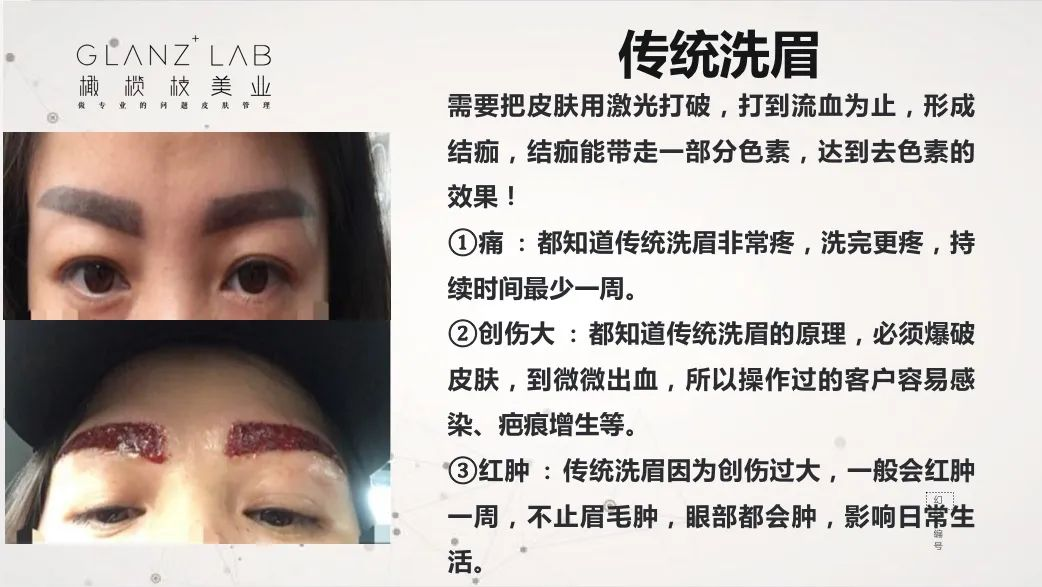 来了解下火爆市场的顶级黑科技无创洗眉技术吧|glanzxlab橄榄枝美业