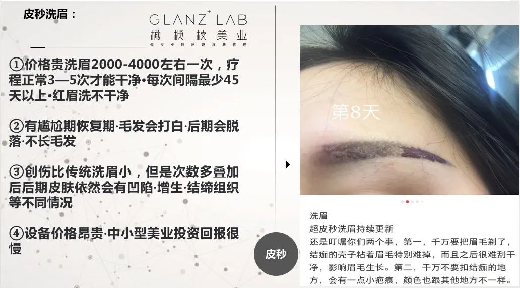 来了解下火爆市场的顶级黑科技无创洗眉技术吧|glanzxlab橄榄枝美业